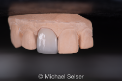 Esthetic Porcelain Buildup Crown