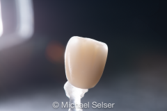 Esthetic Porcelain Buildup Crown
