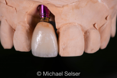 Esthetic Porcelain Buildup Crown on Implant Abutment 