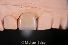 Esthetic Porcelain Buildup Crown
