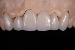 Esthetic Crown Bridge Porcelain Cutback 