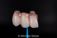 Esthetic Bridge Crown with Porcelain Tissue