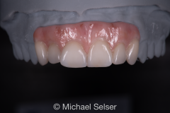 Porcelain cutback with tissue esthetic bridge crown