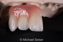 Porcelain cutback with tissue esthetic bridge crown